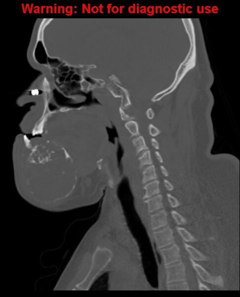 File:Ameloblastoma (Radiopaedia 33126-34164 Sagittal bone window 44).jpg