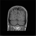 Amnestic syndrome secondary to hypoxic brain injury (Radiopaedia 24743-25004 B 5).jpg