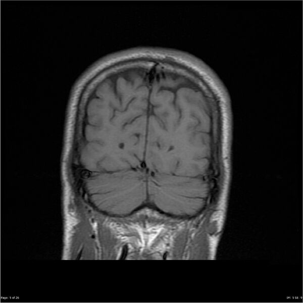 File:Amnestic syndrome secondary to hypoxic brain injury (Radiopaedia 24743-25004 B 5).jpg