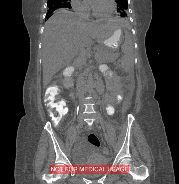 File:Amoebic enterocolitis with liver abscess (Radiopaedia 35100-36609 B 100).jpg
