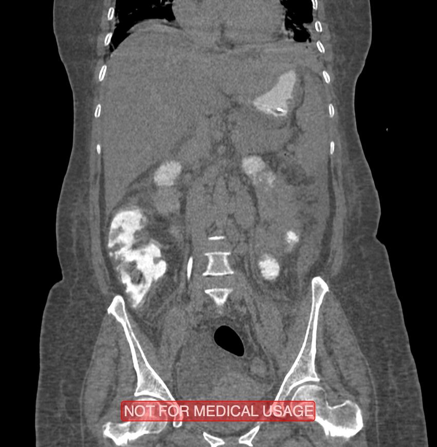 Amoebic enterocolitis with liver abscess (Radiopaedia 35100-36609 B 100).jpg
