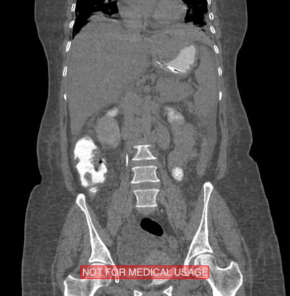 File:Amoebic enterocolitis with liver abscess (Radiopaedia 35100-36609 B 107).jpg