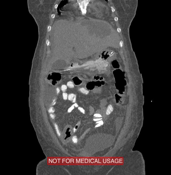File:Amoebic enterocolitis with liver abscess (Radiopaedia 35100-36609 B 32).jpg
