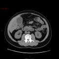 Ampullary carcinoma (Radiopaedia 56396-63056 Axial non-contrast 25).jpg