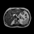 Ampullary tumor (Radiopaedia 27294-27479 T2 19).jpg