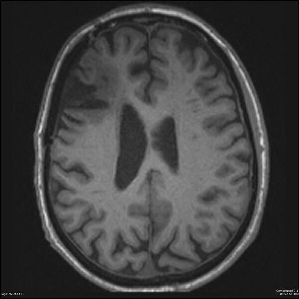 File:Anaplastic meningioma with recurrence (Radiopaedia 34452-35788 Axial T1 90).jpg