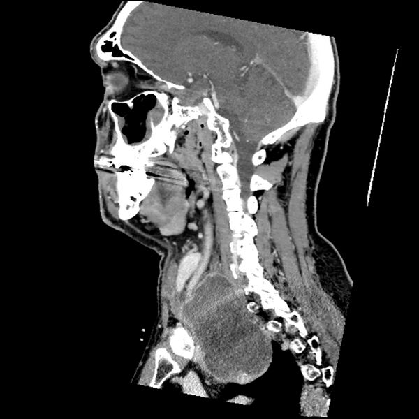 File:Anaplastic thyroid carcinoma (Radiopaedia 79087-92034 C 39).jpg