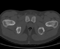 Aneurysmal bone cyst of ischium (Radiopaedia 25957-26094 Axial bone window 68).png