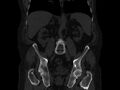 Ankylosing spondylitis (Radiopaedia 44609-48357 Coronal bone window 43).jpg