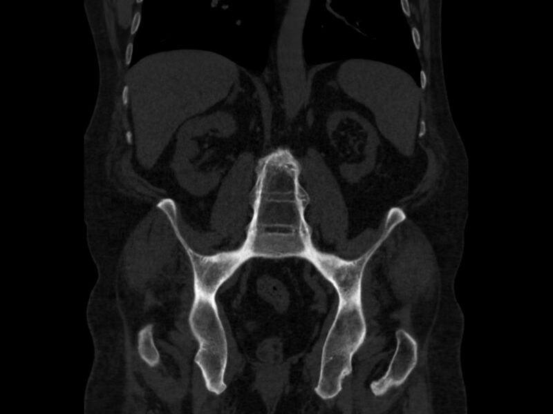 File:Ankylosing spondylitis (Radiopaedia 44609-48357 Coronal bone window 50).jpg