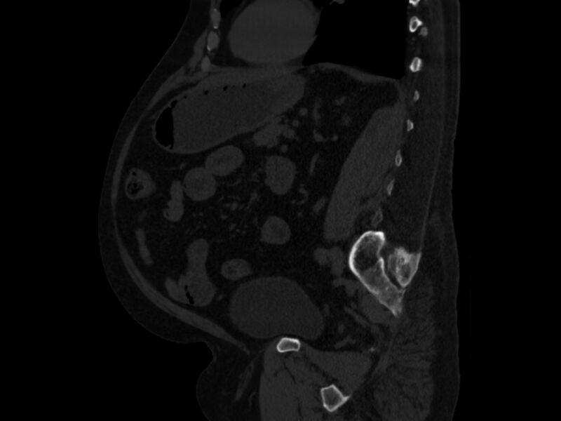 File:Ankylosing spondylitis (Radiopaedia 44609-48357 Sagittal bone window 68).jpg