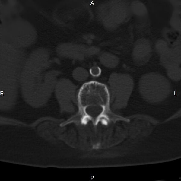 File:Ankylosing spondylitis (Radiopaedia 8748-9556 Axial bone window 32).jpg