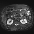 Annular pancreas (Radiopaedia 38292-40320 Axial T2 fat sat 14).png