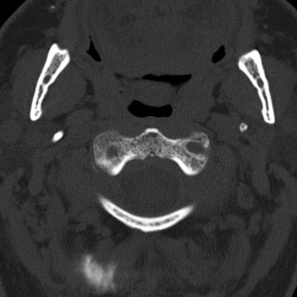 File:Anterior cervical postdiscectomy arthrodesis (Radiopaedia 32678-33646 Axial bone window 17).jpg