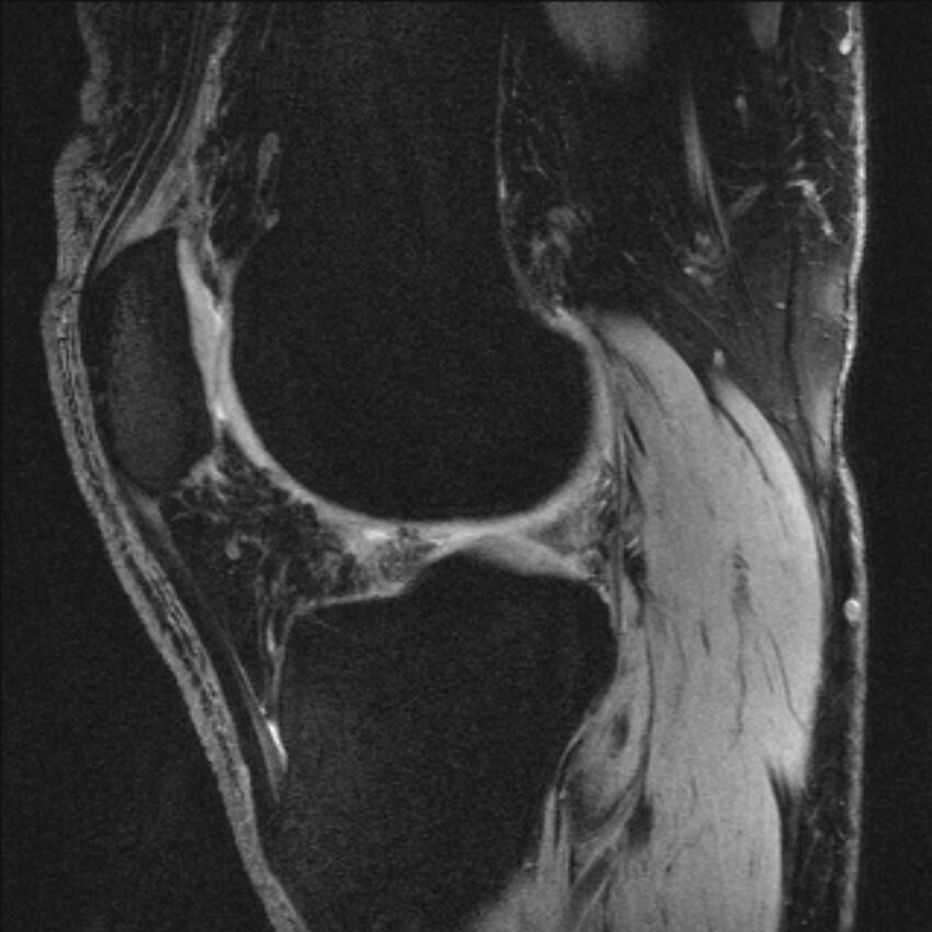 Anterior cruciate ligament mucoid degeneration (Radiopaedia 68400-77933 Sagittal 23).jpg