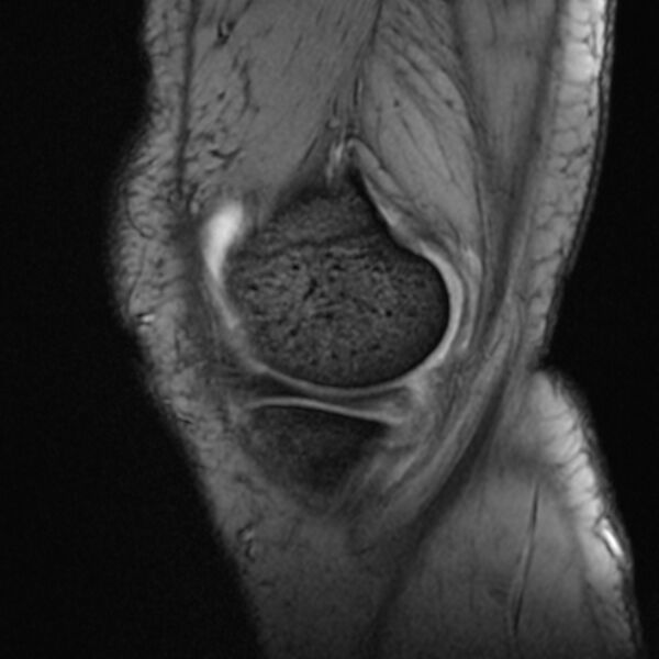 File:Anterior cruciate ligament tear - ramp lesion (Radiopaedia 71883-82322 Sagittal T2 fat sat 21).jpg