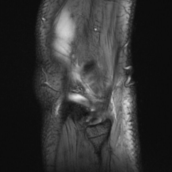 File:Anterior cruciate ligament tear - ramp lesion (Radiopaedia 71883-82322 Sagittal T2 fat sat 3).jpg