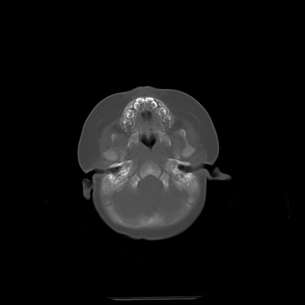 File:Anterior plagiocephaly (Radiopaedia 71836-82273 Axial bone window 1).jpg
