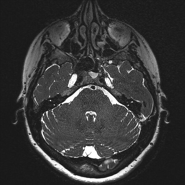File:Anterior temporal encephalocele (Radiopaedia 82624-96808 Axial T2 high res 28).jpg