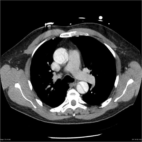File:Aortic dissection- Stanford A (Radiopaedia 37759-39664 A 24).jpg