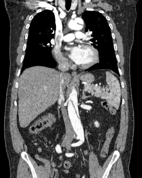 File:Aortic dissection (Radiopaedia 44411-48061 A 23).jpg