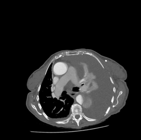 File:Aortic dissection (Radiopaedia 68763-78691 A 22).jpeg