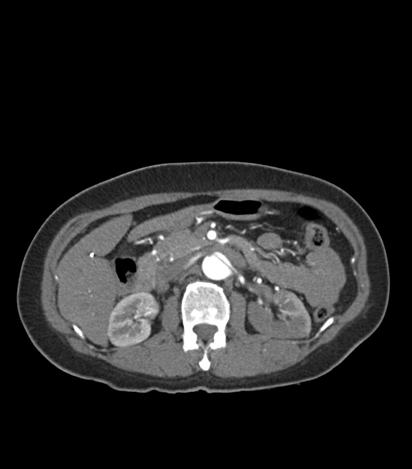 Aortic dissection with renal ischemia (Radiopaedia 76573-88338 A 68).jpg