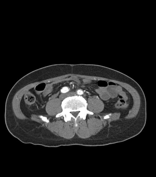 File:Aortic dissection with renal ischemia (Radiopaedia 76573-88338 A 87).jpg