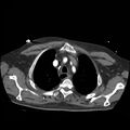 Aortic dissection with rupture into pericardium (Radiopaedia 12384-12647 A 12).jpg