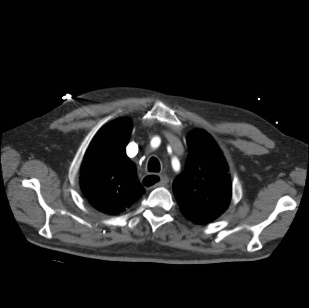File:Aortic dissection with rupture into pericardium (Radiopaedia 12384-12647 A 12).jpg