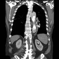 Aortic dissection with rupture into pericardium (Radiopaedia 12384-12647 B 32).jpg