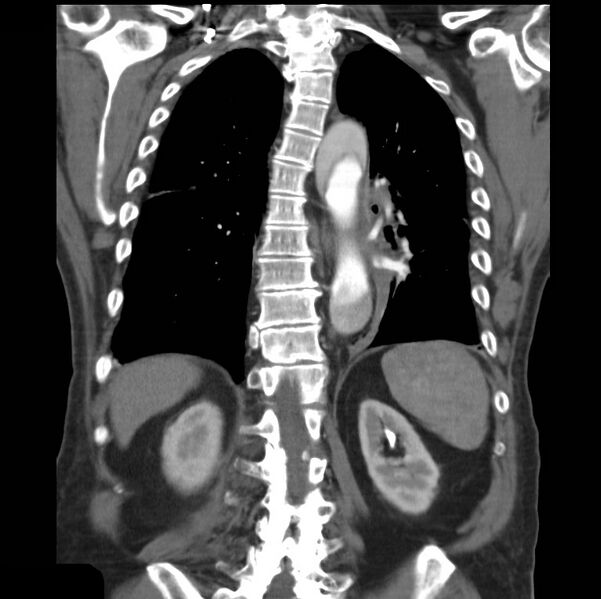 File:Aortic dissection with rupture into pericardium (Radiopaedia 12384-12647 B 32).jpg