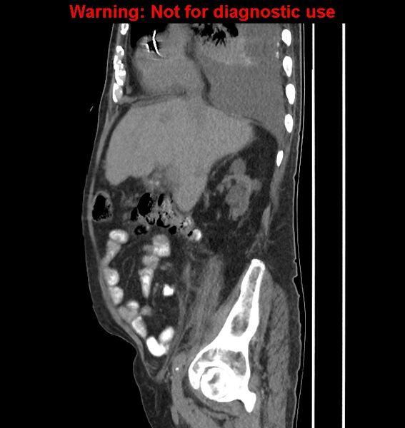 File:Aortic graft infection (Radiopaedia 44979-48907 C 47).jpg