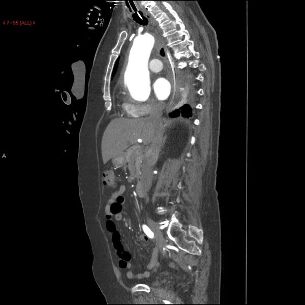 File:Aortic intramural hematoma (Radiopaedia 27746-28001 C 24).jpg