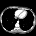 Aortic valve non-coronary cusp thrombus (Radiopaedia 55661-62189 B 37).png