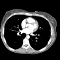 Aortic valve non-coronary cusp thrombus (Radiopaedia 55661-62189 C 1).png
