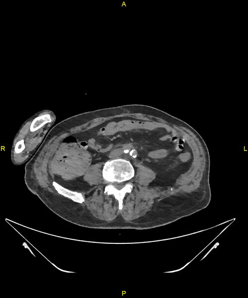 File:Aortoenteric fistula (Radiopaedia 84308-99603 Axial non-contrast 226).jpg