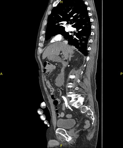 File:Aortoenteric fistula (Radiopaedia 84308-99603 C 140).jpg
