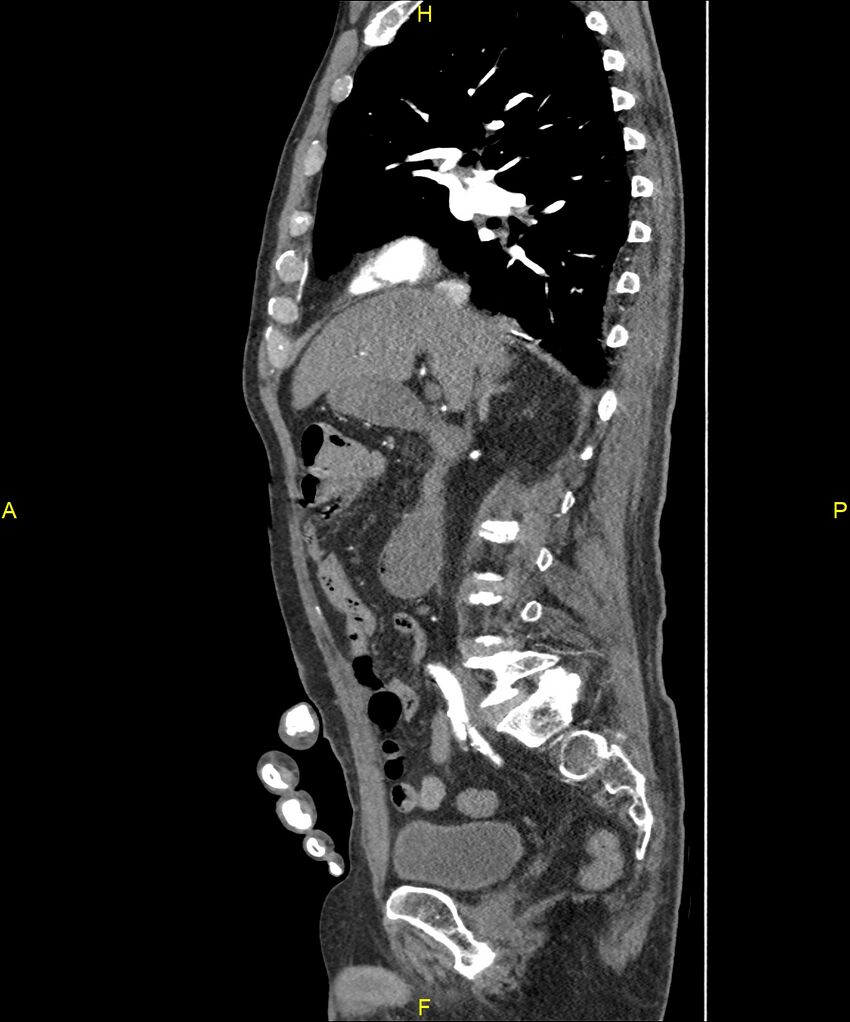 Aortoenteric fistula (Radiopaedia 84308-99603 C 140).jpg