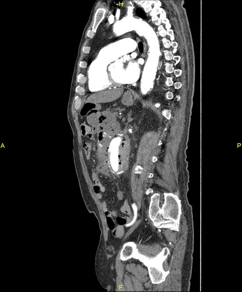 File:Aortoenteric fistula (Radiopaedia 84308-99603 C 207).jpg