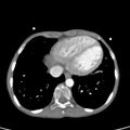 Aortopulmonary window, interrupted aortic arch and large PDA giving the descending aorta (Radiopaedia 35573-37074 B 72).jpg