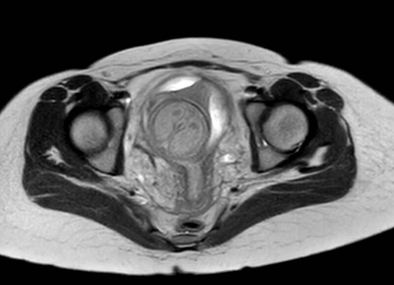 File:Appendicitis in gravida (MRI) (Radiopaedia 89433-106395 Axial T2 64).jpg