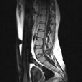 Arachnoid cyst - spinal (Radiopaedia 66835-76157 Sagittal T1 6).jpg