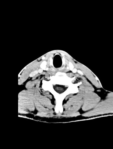 File:Arrow injury to the face (Radiopaedia 73267-84011 Axial C+ delayed 1).jpg