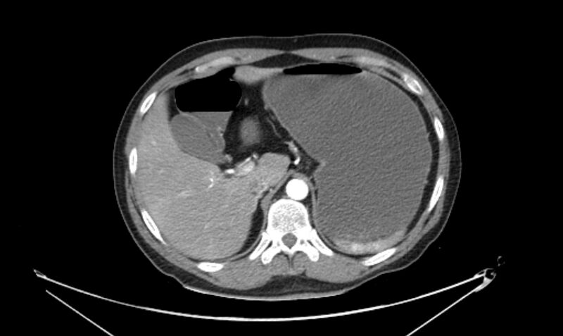 File:Arterial occlusive mesenteric ischemia (Radiopaedia 84641-100060 A 35).jpg
