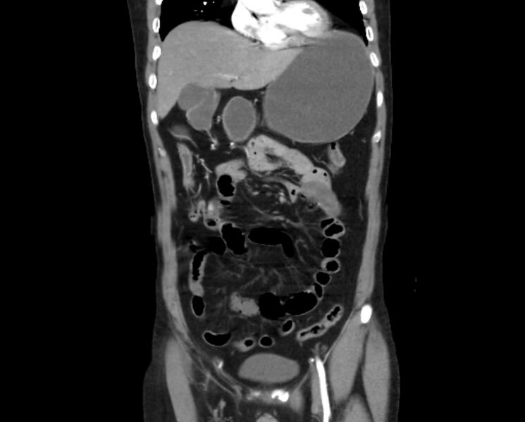 File:Arterial occlusive mesenteric ischemia (Radiopaedia 84641-100060 B 18).jpg