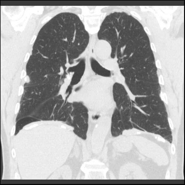 File:Asbestos-related pleural plaques (Radiopaedia 39069-41255 Coronal lung window 38).jpg
