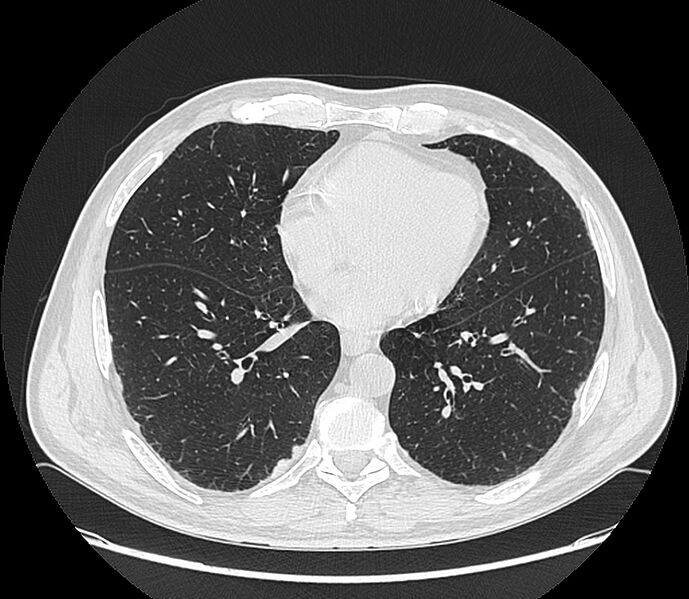 File:Asbestos pleural placques (Radiopaedia 57905-64872 Axial lung window 155).jpg