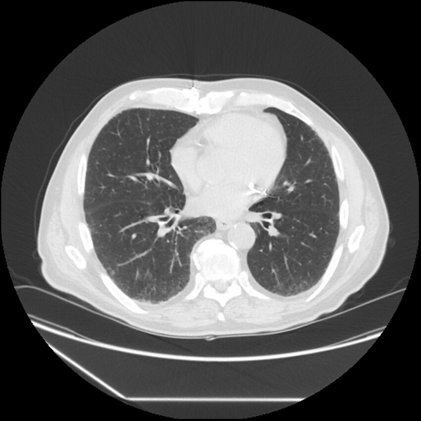 Asbestosis complicated by lung cancer (Radiopaedia 45834-50116 Axial lung window 41).jpg