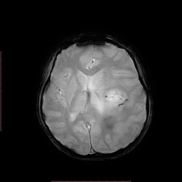 File:Astroblastoma (Radiopaedia 74287-85162 Axial SWI 12).jpg
